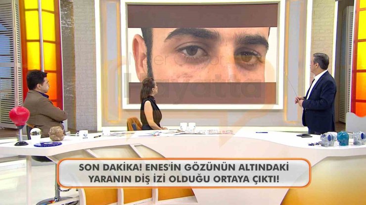 CANLI YAYINDA ENES GÜRAN’IN GÖZÜNÜN ALTINDAKİ DİŞ İZİNE DİKKAT ÇEKİLDİ